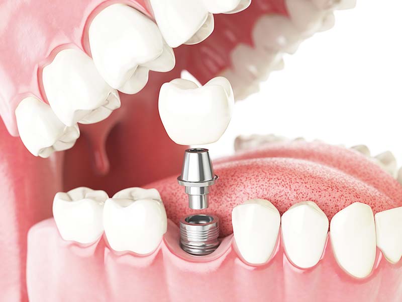 植牙探討:即拔即種