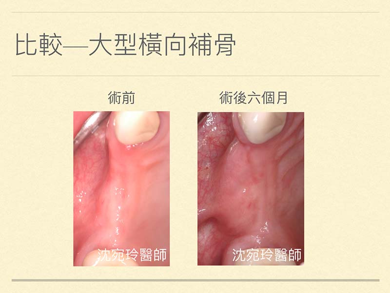 談植牙「多顆牙大型橫向補骨」