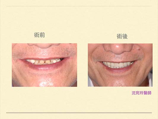 談『全口重建』