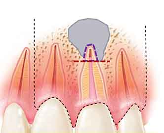 淺談「顯微根尖手術」的成功關鍵！ [佳誠的用心，請您安心]