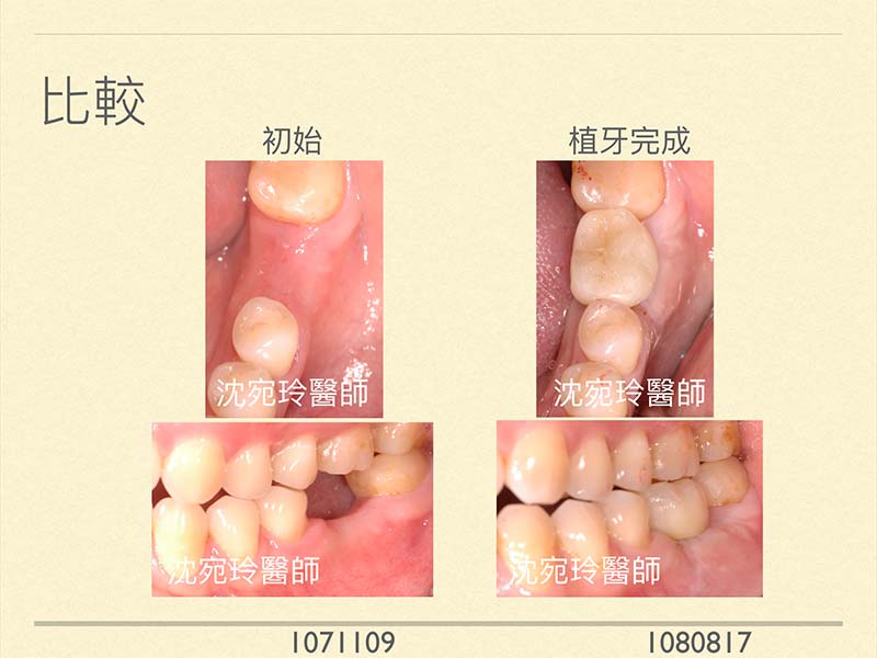 『淺談植牙成功率』[佳誠的用心 請您放心]