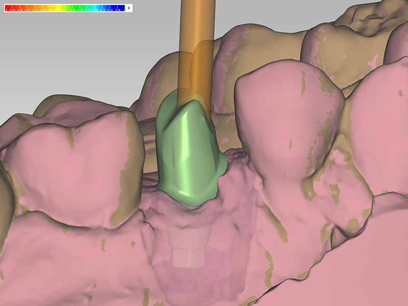 電腦設計客製化支台齒