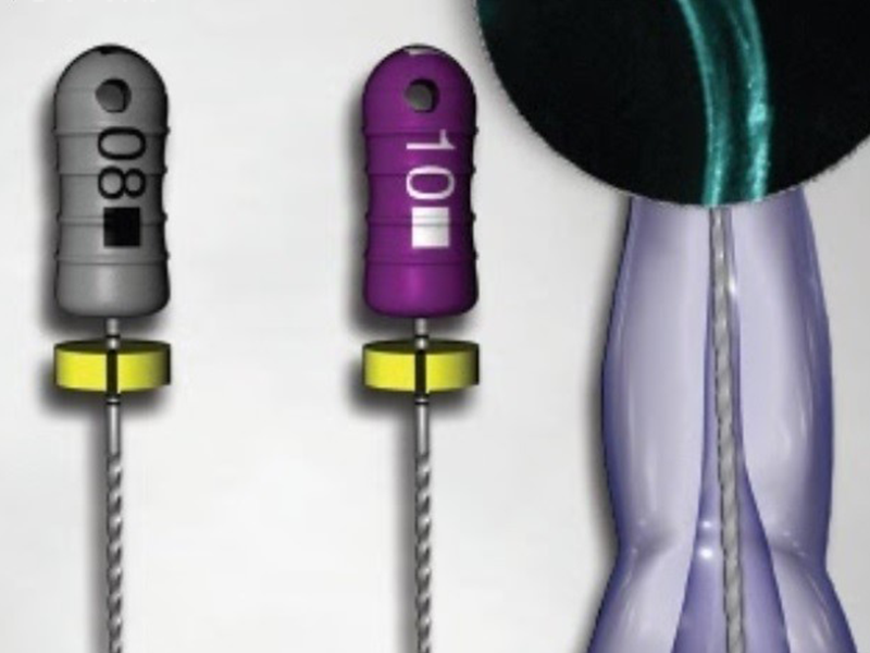 根管通不下去怎麼辦? 什麼是「鈣化根管」?