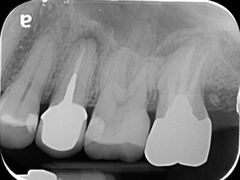 嚴重根管感染引起鼻竇炎，怎麼辦?