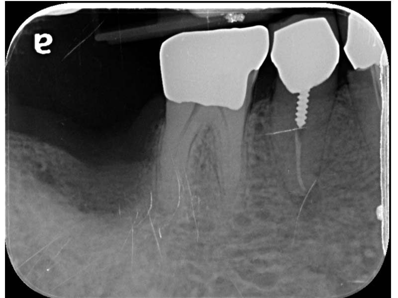 困難植牙利用帳篷釘