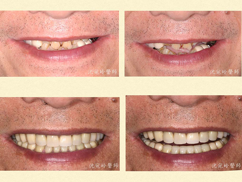 案例分享『全口重建』