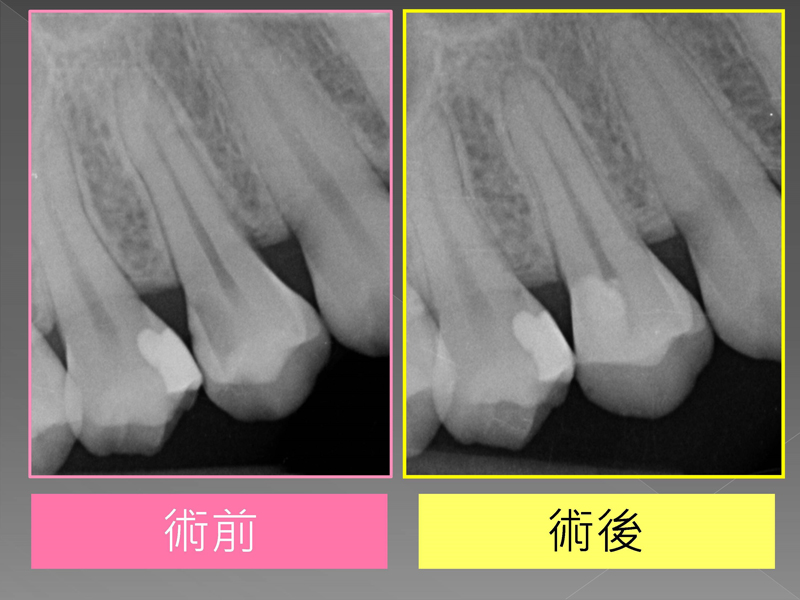 案例分享『活性牙髓治療(覆髓)- 蛀牙免根管治療的新選擇!』