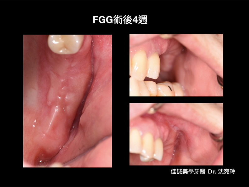 案例分享『上顎後牙區角質化上皮移植術(FGG)』