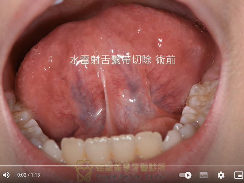 案例分享『第三代LITETOUCH水雷射舌繫帶切除』