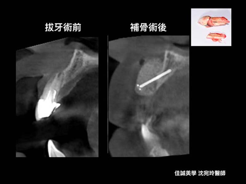 案例分享『牙齒斷裂，利用水雷射補骨重建』