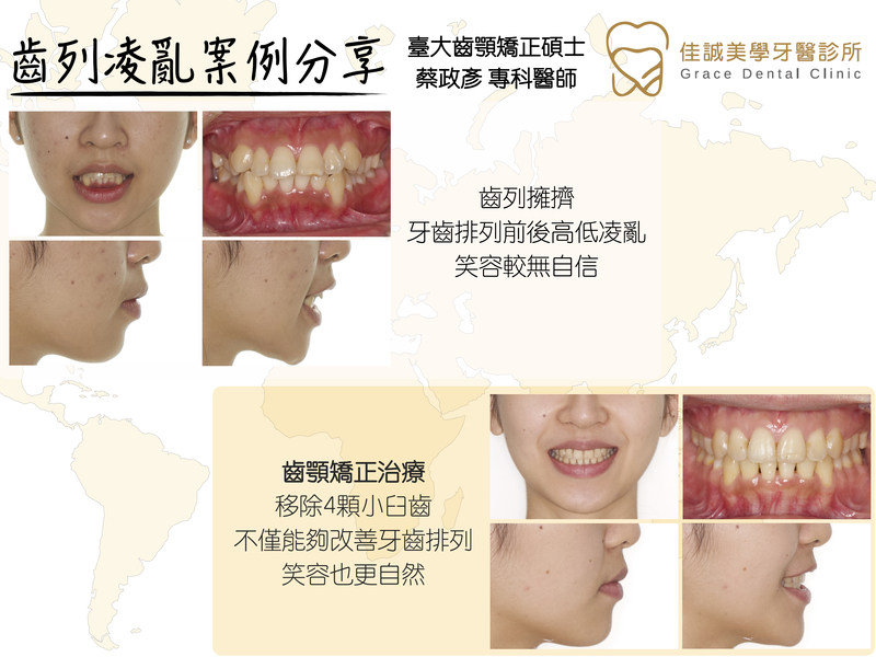 案例分享『牙齒凌亂，不敢開懷大笑該怎麼辦？』