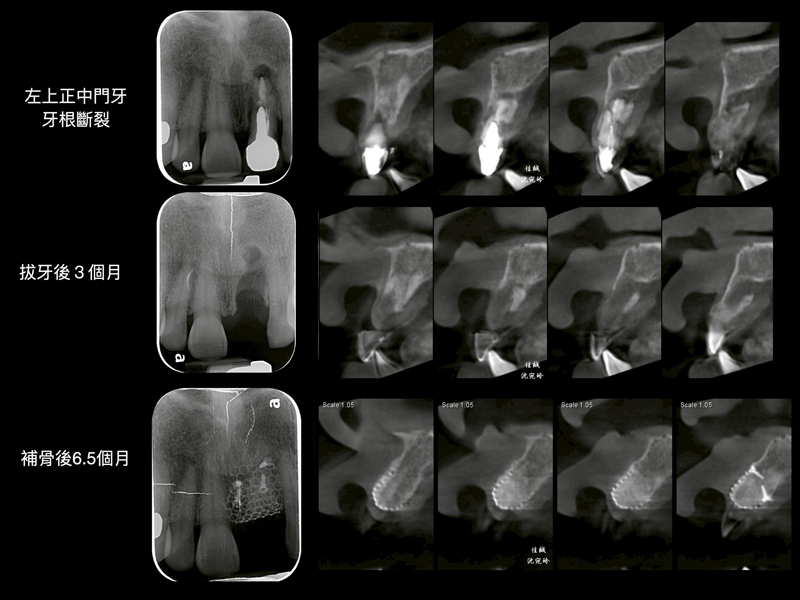 案例分享『困難植牙』