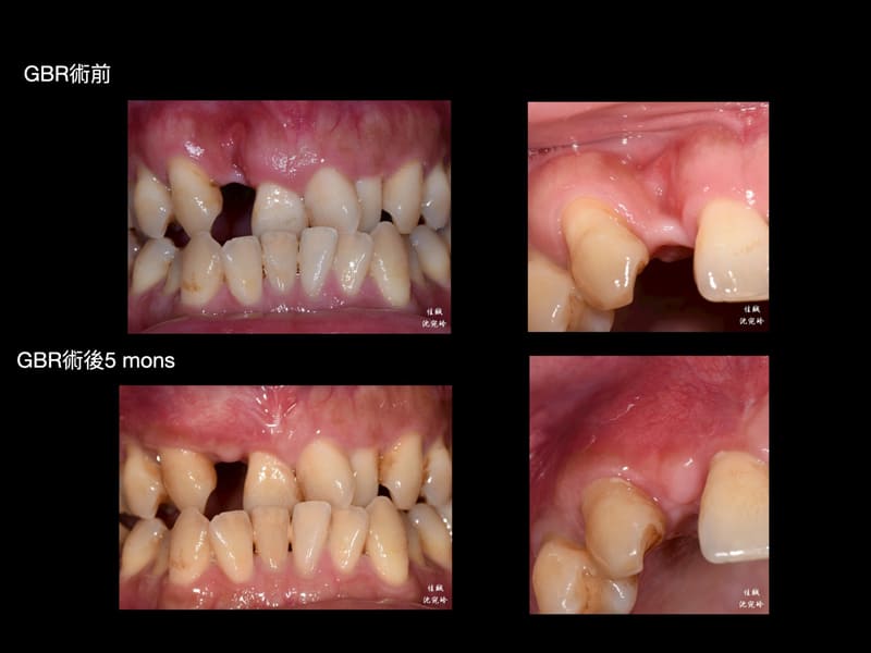 案例分享『矯正前之困難補骨』